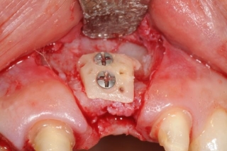 Bone graft for dental implant