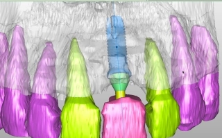 3-D model of implant / jaw bone