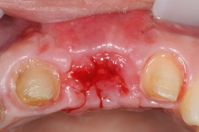 Healing of bone and gum tissue
