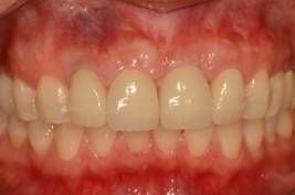 Final crown upper tooth