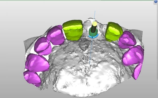 3-D model of implant position