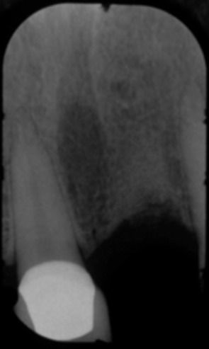 Xray of missing upper tooth