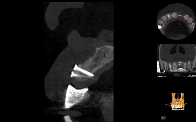 cone beam CT scan for implant