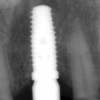 Final implant upper tooth