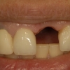 Missing mixillary incisor
