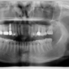 panorex missing upper tooth