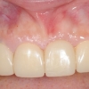 Temporization after implant
