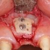 Bone graft for dental implant