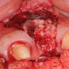 particulate bone graft for implant