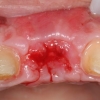 Healing of bone and gum tissue