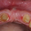 Placement of implant