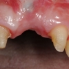Implant placement