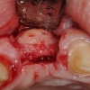 Flap for implant placement