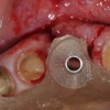 Surgial guide for implant placement