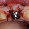 Dental implant placement