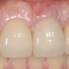 Final crown on dental implant
