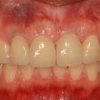 Final crown upper tooth