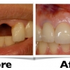 implant-before-and-after-2