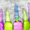 3-D model of implant / jaw bone