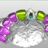 3-D model of implant position