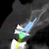 cone beam CT scan 3-d implant planning