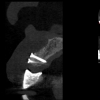 cone beam CT scan for implant