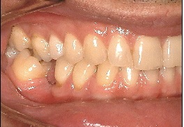 Missing lower left molar