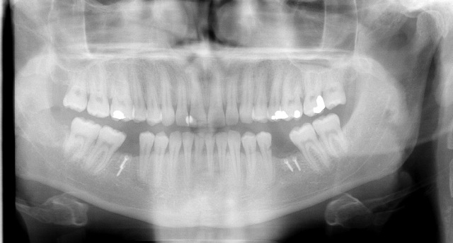 X-ray after bone grafting