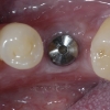 Implant lower left side
