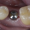 Implant lower right side