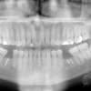 X-ray after bone grafting