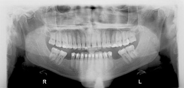 Missing lower molars