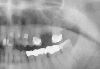 Missing tooth #14