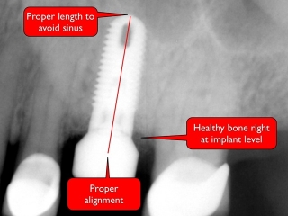 Proper dental implant placement