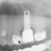 Dental implant placement with crown