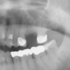 Missing tooth #14