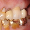 Implant crown in bite