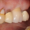 Implant crown- Dr. Kazemi oral surgeon