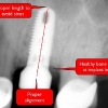 Proper dental implant placement
