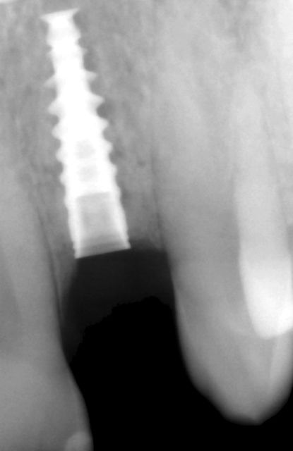 dental Implant xray