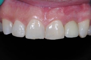 Final implant crown