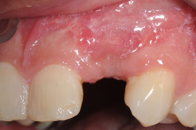 Clinical view of missing tooth