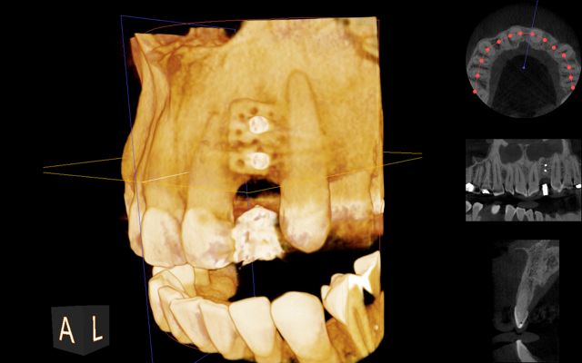 dental ct scan after bone graft