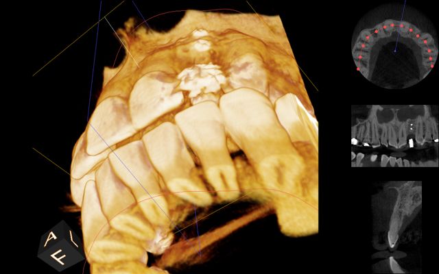 dental ct scan after bone graft