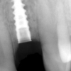 dental Implant xray
