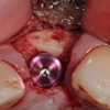 dental implant placed