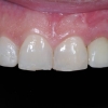 Final implant crown