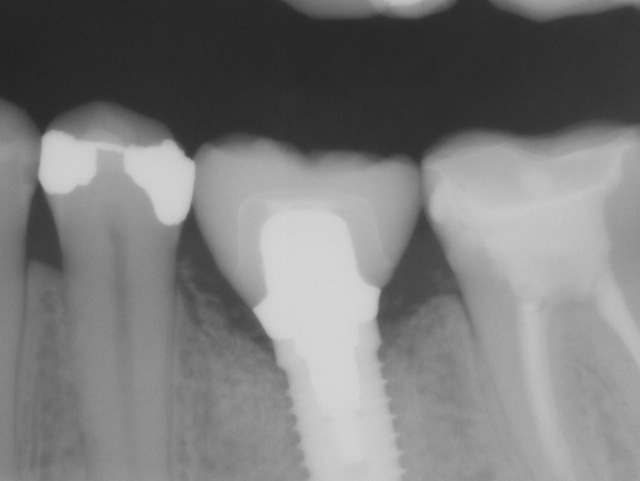 Implant lower molar
