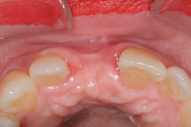 Bone atrophy (shrinkage) after extraction