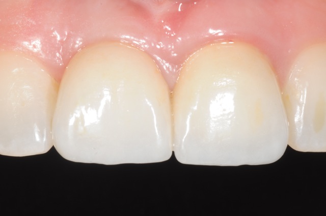 Implant crown in the front tooth